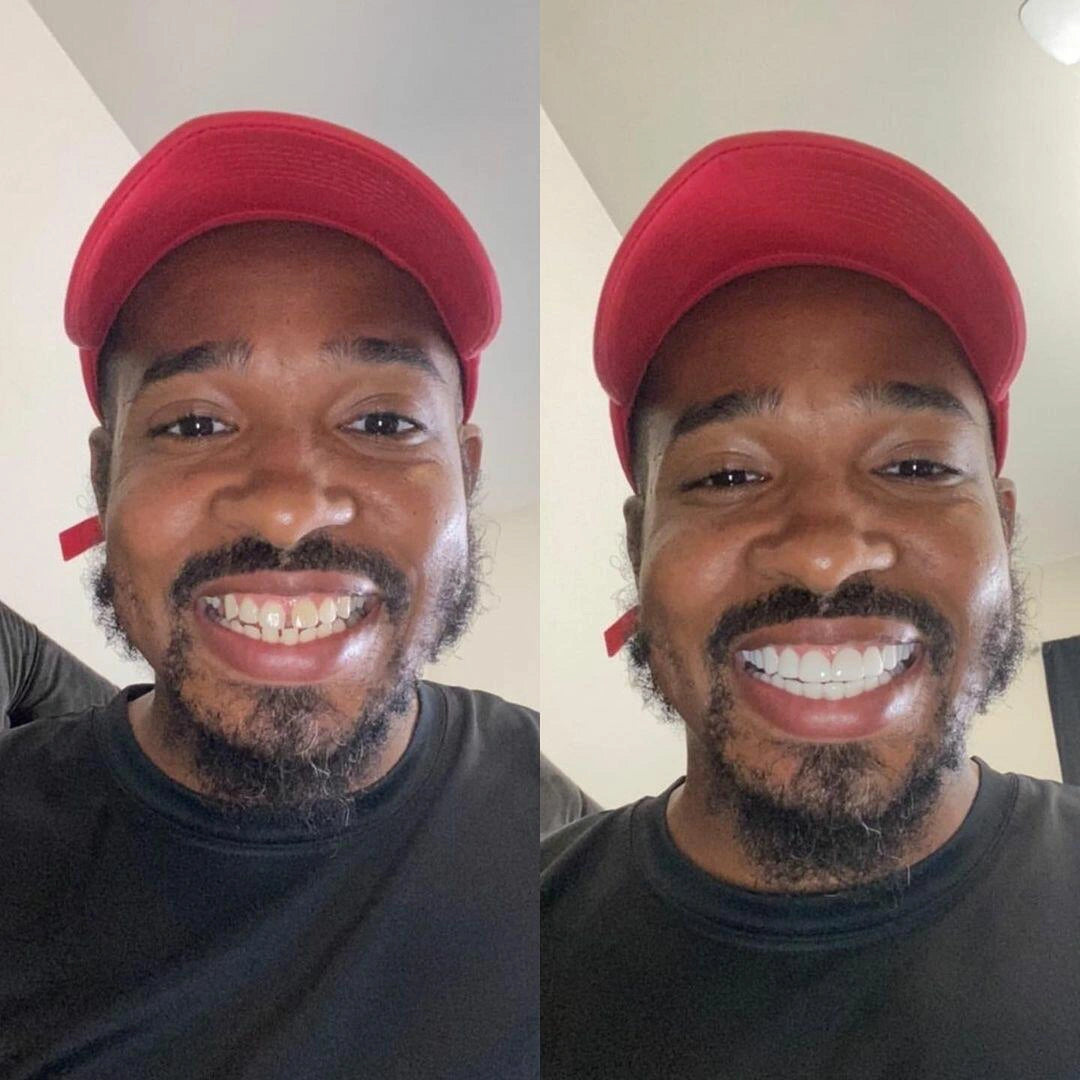 GlowSmile™ | Instant Snap-On Veneers