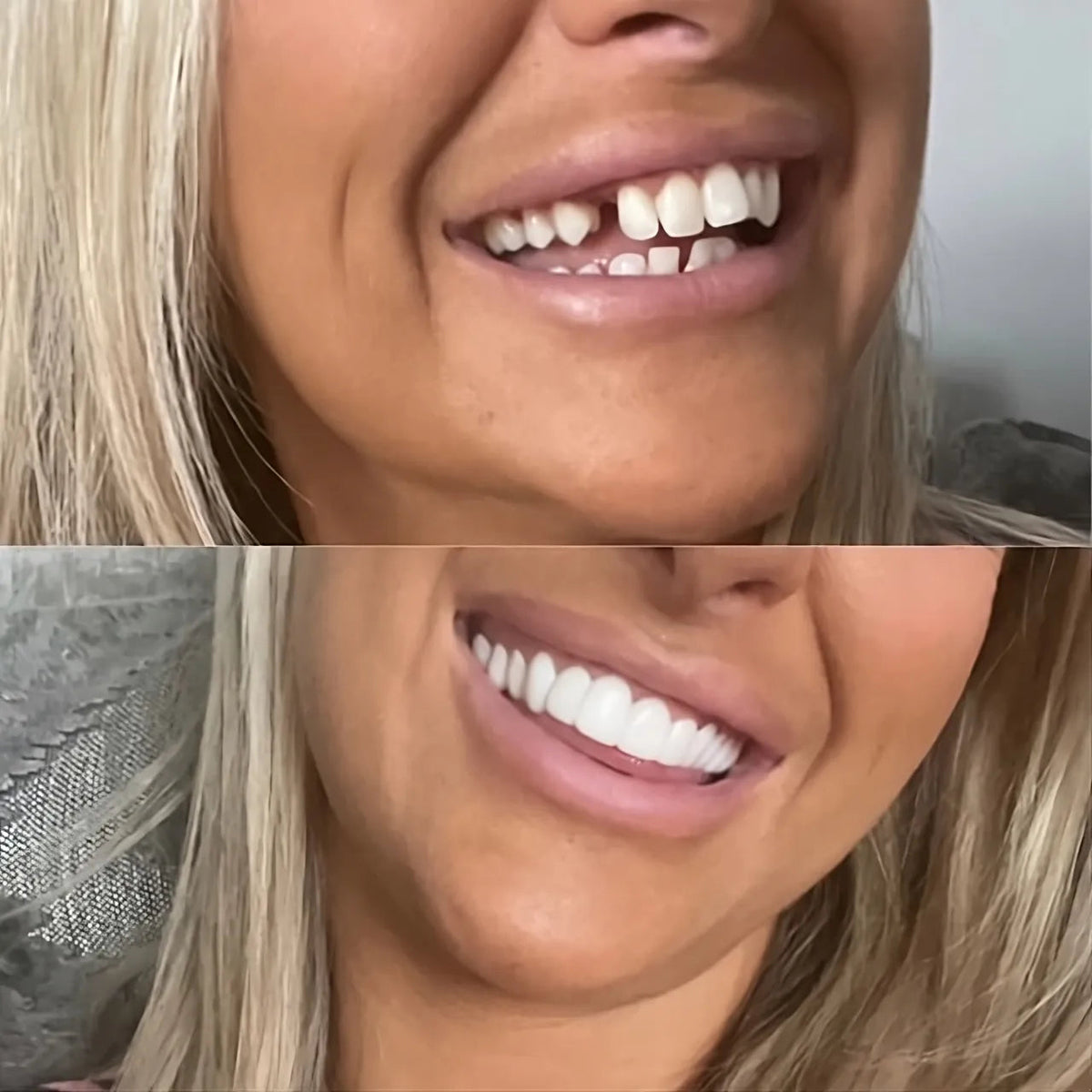 GlowSmile™ | Instant Snap-On Veneers